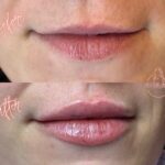lip filler Bicester & Wantage