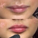 lip filler Bicester & Wantage