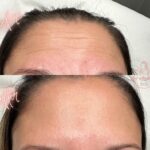 anti wrinkle treatment Bicester & Wantage