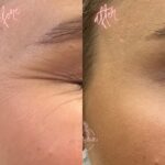 anti wrinkle injections Bicester & Wantage