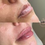 lip filler Bicester & Wantage