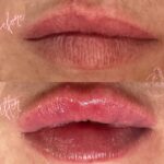 lip filler Bicester & Wantage