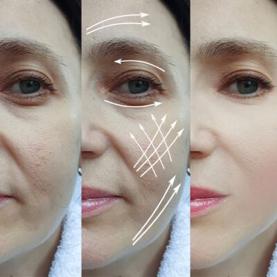 Skin boosters (2) Bicester & Wantage